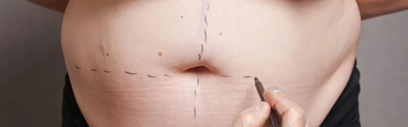 Abdominoplastia: como devolve a sua confiança após a diástase abdominal